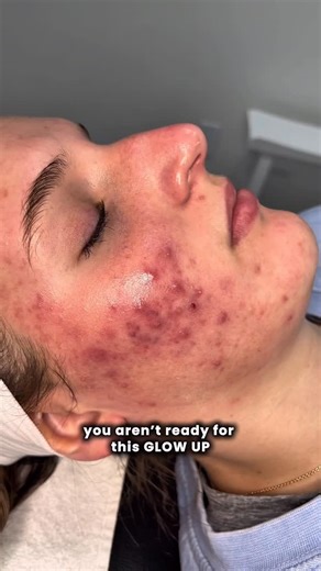 Maddie Tooze Acne Specialist on Instagram: "This transformation still gives me chills 🥹 We used a combo of Mixi Skincare homecare, Mixi Peel Treatments, and @procelltherapies to rebuild her barrier, calm inflamed acne lesions, heal PIE, and target every layer of scarring. It wasn’t overnight, it was 20 months investing time, money, trust, and a lot of consistency 👏🏼 I’ve done 16 Procell Microchanneling treatments on her so far, paired with Mixi Peels. I’m sharing that num