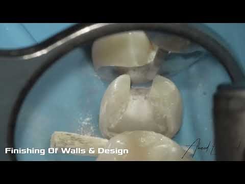 Management of Deep Caries & Indirect restorations