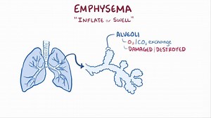 Video: Emphysema - Video Explanation! | Osmosis | Osmosis