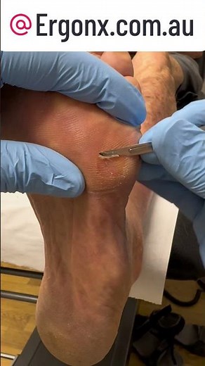 Oddly Satisfying Hard Corn Removal with Scalpel by Podiatrist #Podiatry #SatisfyingRoutine