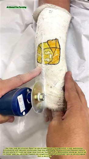 Entfernung eines orthopädischen Gipsverbandes: Sicheres Durchtrennen eines Gipsverbandes