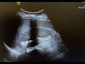 Ultrasound of emphysematous pyelonephritis