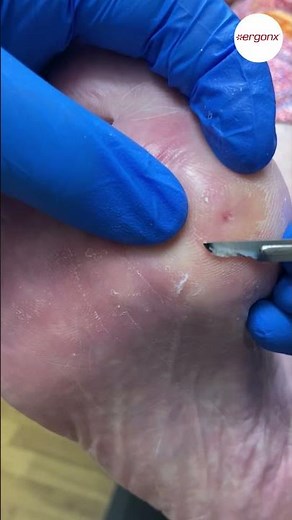 Corn Removal by Podiatrist