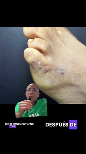 PUBLIC SERVICE ANNOUNCEMENT REGARDING CORN REMOVAL SURGERY‼️⚠️#shorts