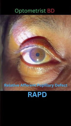 Relative Afferent Pupillary Defect - RAPD