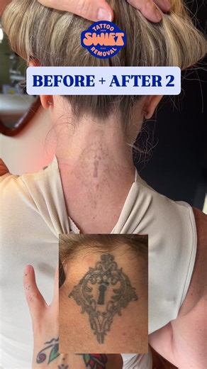 First treatment: end of August ‘25 Second treatment: end of October ‘25 After photo: taken today ✨ The speed of progress on this tattoo has been phenomenal. Results like this are helped by the age of the tattoo (around 15 years old) and the location — which has undoubtedly seen a fair bit of 🌞 over the years. Older tattoos and sun exposure can naturally start to break down pigment over time, which means the laser has less work to do. Every tattoo responds differently, but this is a great exampl