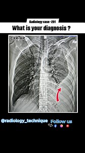 Radiology case-291 A 52 year old patient presented chronic chest pain with Shortness of breath and mild fever.. What is your diagnosis ? #radiology_technique #viralreels #medicogirl #Pulmonologists #radiographer #radiology #disease #fb #lung #xray #CXR #radiologia #mbbsstudent #mbbs #medicos #medico | Diwakar Patel
