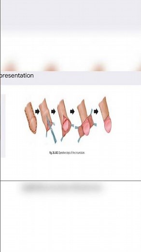 Steps of circumcision #mbbs #bams #bhms #fypシ #fypviralシ
