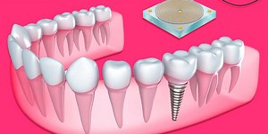 New Sensor Integrated Within Dental Implants Monitors Bone Health
