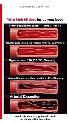 🩸 What High BP does inside your body ⚠️ | MDCT