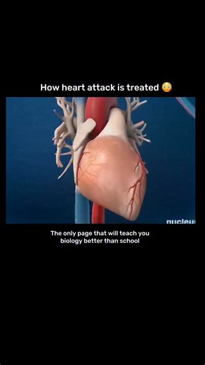 medical / biology explain on Instagram: "A heart attack is treated as a medical emergency. The first step is to restore blood flow to the heart as quickly as possible. Patients are given medications like aspirin (to prevent clotting), thrombolytics (to dissolve clots), nitroglycerin (to improve blood flow), and pain relievers. In hospitals, procedures such as angioplasty with stent placement or coronary artery bypass surgery may be performed to reopen or bypass blocked arteries. Long-term treatm
