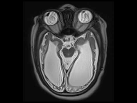 Periventricular Leukomalacia