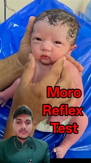 Yogesh Medicare YT on Instagram: "Moro reflex test #mororeflex #newborntest"