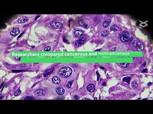 Loss of PTEN expression causes metabolic reprogramming in hepatocellular carcinoma