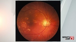 Simple eye test predicts early death from chronic illness within 10 years