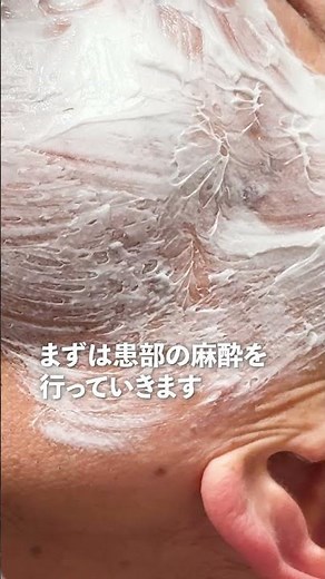 【シミ取り】老人性いぼとは？1回の施術でこんなに美しく #シンシアガーデンクリニック #美容 #美容皮膚科#いぼ #しみ【群馬県太田市・高崎市の美容皮膚科】