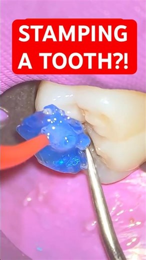 This Filling Technique Copies the Tooth PERFECTLY 🤯🦷