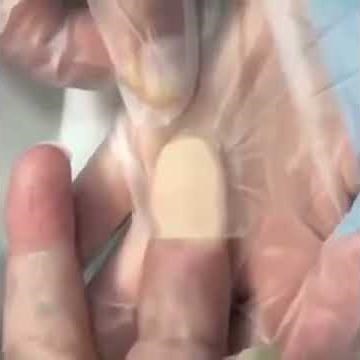 Capillary Refill Time (CRT) Testing - ANDROMEDA-SHOCK perfusion protocol