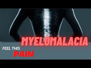 What You Need To Know About Myelomalacia