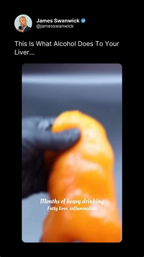 The progression from a healthy liver to inflammation and eventual failure is a direct result of the "poison" we've normalized in our culture. Whether it's the fatty liver that develops after months of heavy drinking or the scarring and cirrhosis that follow years of use, the internal cost of alcohol is permanent and devastating. Follow @jamesswanwick for the best alcohol-free content! #alcoholfree #quitdrinking #wine #alcohol | Alcohol Free Lifestyle