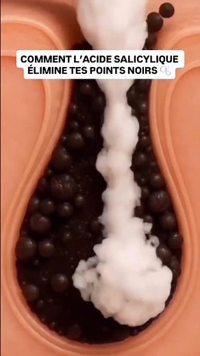Tu t’es déjà demandé comment l’acide salicylique réussit à déloger ces points noirs bien accrochés