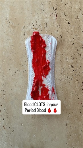 Rashi Chowdhary on Instagram: "If you’re seeing clots during your period, this is something you should understand and not ignore. Those clots are not just blood. They’re pieces of your uterine lining shedding. Here’s what’s usually happening: Estrogen is an anabolic hormone. It builds tissue and every month, estrogen helps build up your uterine lining so the body can prepare for a possible pregnancy. Progesterone’s job is to balance estrogen and keep that lining stable. But when estrogen is too 