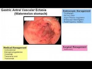 Gastric Antral Vascular Ectasia GAVE Or Watermelon Stomach ; Causes, symptoms, Diagnosis, treatment