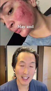 Incredible Cystic Acne Before and After #shorts acne