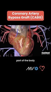 24K views · 25 reactions | 變Coronary Artery Bypass Graft (CABG)...