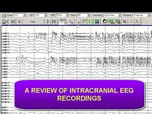 INTRACRANIAL DEPTH ELECTRODE RECORDING
