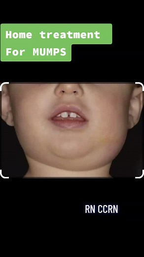 How to treat mumps at home ..