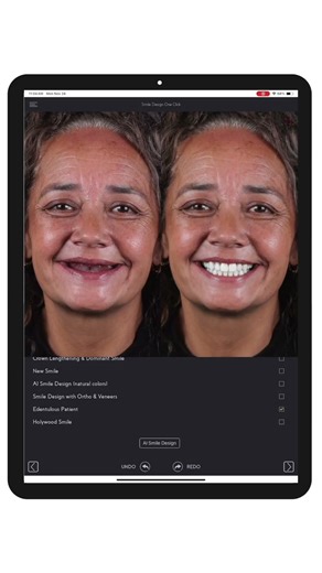 SmileFy ONE CLICK AI Smile Simulation