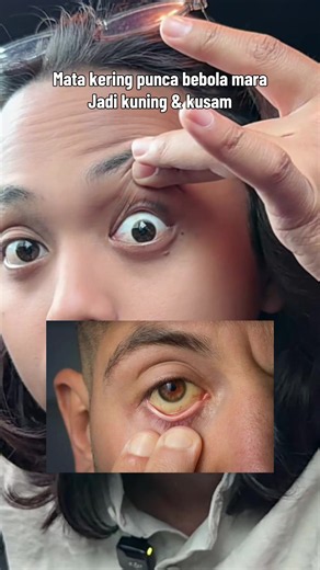 Cara Atasi Mata Kuning dan Kusam dengan Eye Drops yang Sesuai