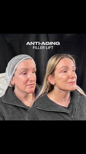 Vortex Technique: The Key to Natural Volume 💉 Volumizing the face isn’t just about adding filler—it’s about strategic placement to enhance structure and restore lost dimension. ✔ Multi-plane approach – Targets different tissue layers for seamless integration. ✔ Natural lift – Creates volume without overfilling or heaviness. ✔ Longevity – Supports facial contours with precise distribution. Master advanced volumizing techniques—comment “Facial Profiling” to join the training! #dermalfillers #faci