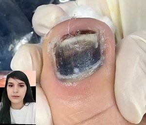 Toenail Fungus Treatment: Step-by-Step Pedicure Guide