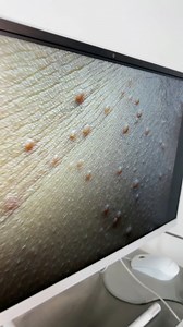 🦠El molusco contagioso es una infección viral de la piel causada por el virus del molusco. Se caracteriza por la presencia de pequeñas protuberancias en la piel con un centro perlado y la transmisión puede ocurrir durante el contacto íntimo.🚨Síntomas Comunes:👇🏻🚫 Picazón o Irritación: Puede causar molestias leves en la zona afectada.⚠️ Si notaste cambios en tu zona genital u observaste lesiones similares a las que se muestran en el video, agenda tu cita para una evaluación.💕 #molusco #molus