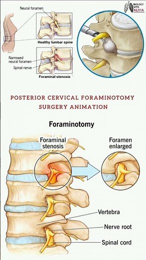 Posterior Cervical Foraminotomy Surgery Animation #spine #neck #lumbar #shorts