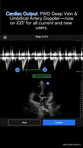 iQ3 New Features | Butterfly Network
