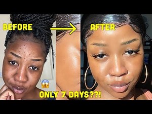 HOW I CLEARED MY SKIN in 1 WEEK!!!! and LIGHTENED my dark under eye circles