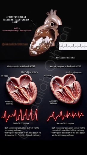 Orthodromic vs. Antidromic AVRT: The Loop Determines the QRS In AVRT, the circuit includes both the native conduction system and an accessory pathway (AP). The direction of impulse travel dictates the ECG morphology. 🔁 Orthodromic AVRT (Narrow QRS) • Down: AV node → His-Purkinje system (normal ventricular activation). • Back: Retrograde via the AP to the atria. • ECG: Narrow complex (unless aberrancy). ⚡ Antidromic AVRT (Wide QRS) • Down: AP directly into the ventricle (pre-excitation). • Back: