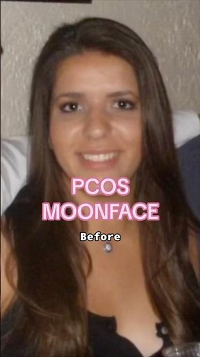 Do you struggle with PCOS moon face? Here’s what helped me get rid of it! #pcos