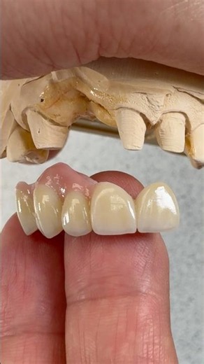 Monet Pure Zirconia restoration for Dr. Marvin McQueen in Mississippi
