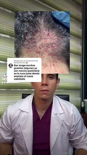 Cómo tratar la foliculitis del cuero cabelludo en casa