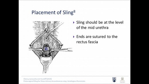 Video Presentation 03 PUBOVAGINAL SLING FOR STRESS URINARY INCONTINENCE USING AUTOLOGOUS FASCIA LATA A. Clancy1; M. Larouche2;