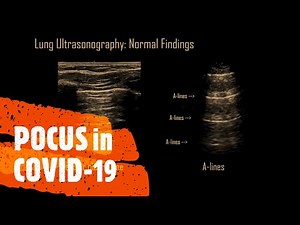 POCUS in COVID 19 - diagnosis, progression, endotracheal intubation, utility