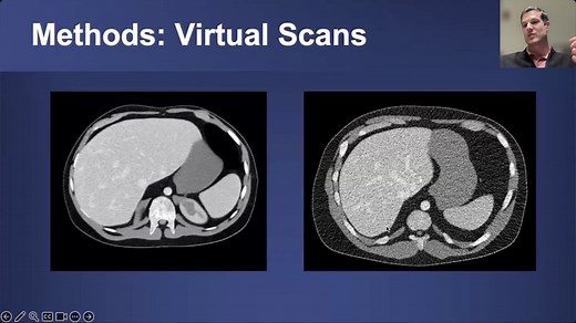 Photon-counting CT in Abdominal Imaging: Hype or Actual Utility? - CVIT - Center for Virtual Imaging Trials