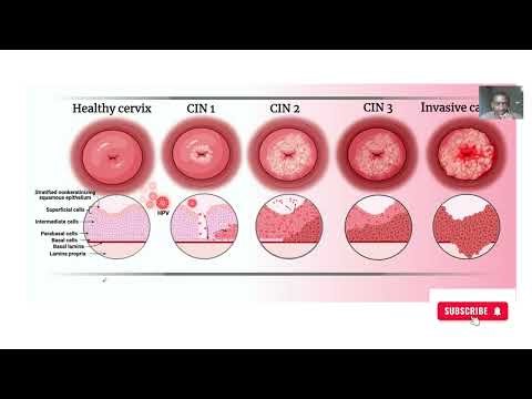 Premalignant lesions of the cervix; precede invasive cervical cancer