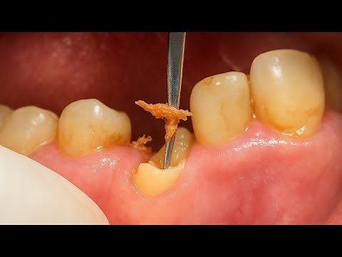 Build-Up of Canine Tooth with Fiber Post and Composite After Root Canal Treatment | Dental Case