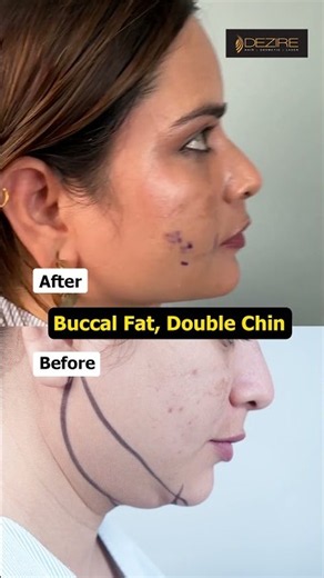 Buccal Fat, Double Chin Result