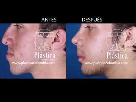 Caso de antes y después cirugía de nariz con cirugía de mandíbula